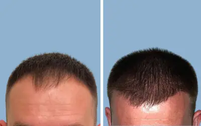 Before and After